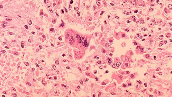 Histopatología de la neumonía por sarampión